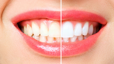 Unlock the Secret to Pearly Whites—Without Harsh Chemicals!